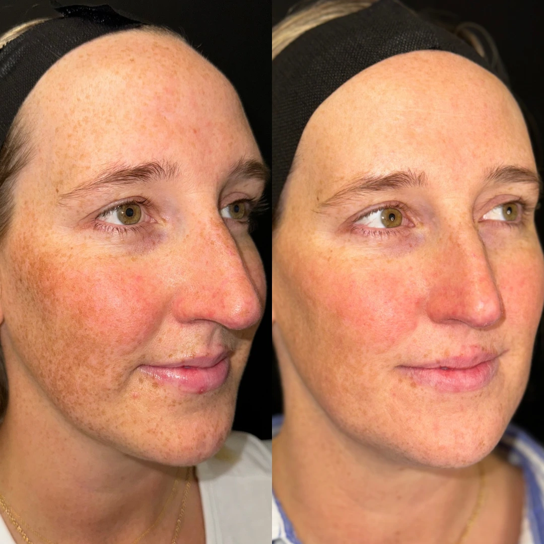 Before and after comparison of uneven skin tone treatment, showing improved skin clarity and even complexion